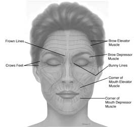 Lift on Use Botox Injections For Wrinkles And A Face Lift Too