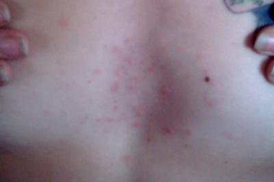 bumpy rash on chest #10