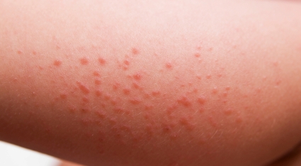 lumpy skin rash