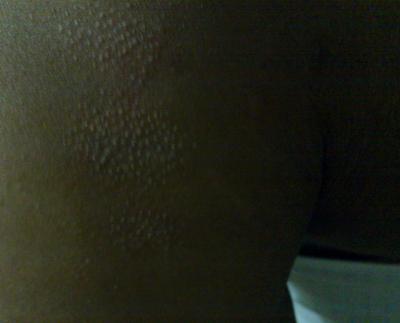picture of skin rash - what is