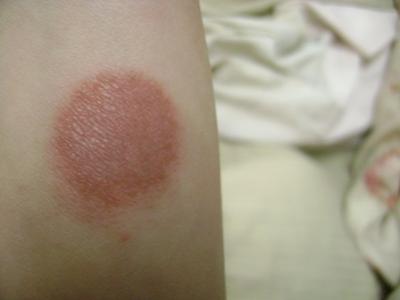 Round, red spot on leg? - Long Island Families