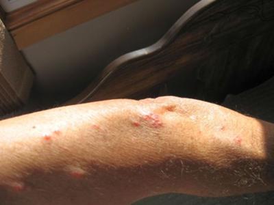 Arm Rash - Symptoms, Causes, Treatments - Healthgrades