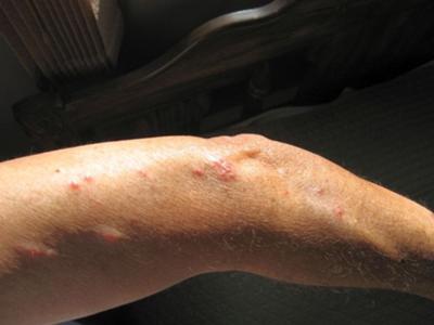 heat rash on arms. Help clear your dog#39;s hot