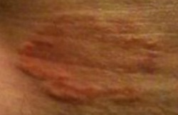 red rash in crotch area please help? | Yahoo Answers