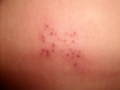 red bumpy rash on legs #10