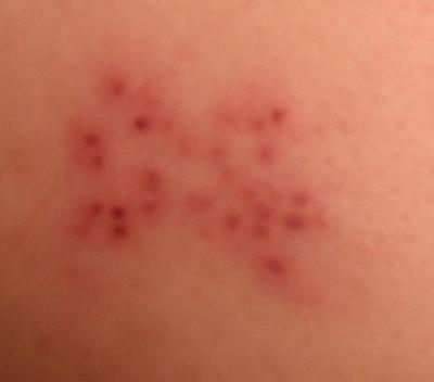 red bumpy rash on legs