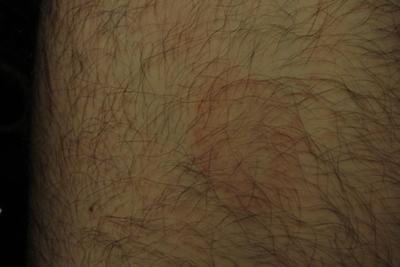 round rash - Dermatology - MedHelp