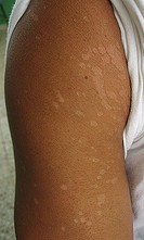 White Spots On Skin From Tanning