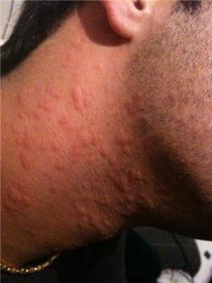 Face,Neck,chest rash - Dermatology - MedHelp