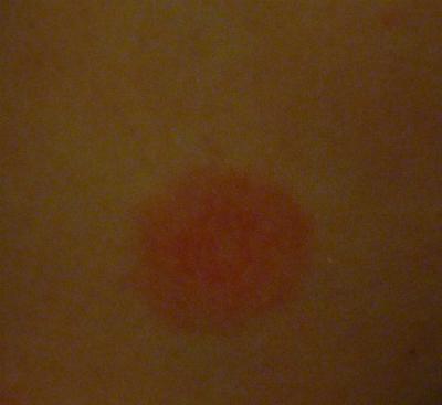 Red Spots on Legs - Buzzle