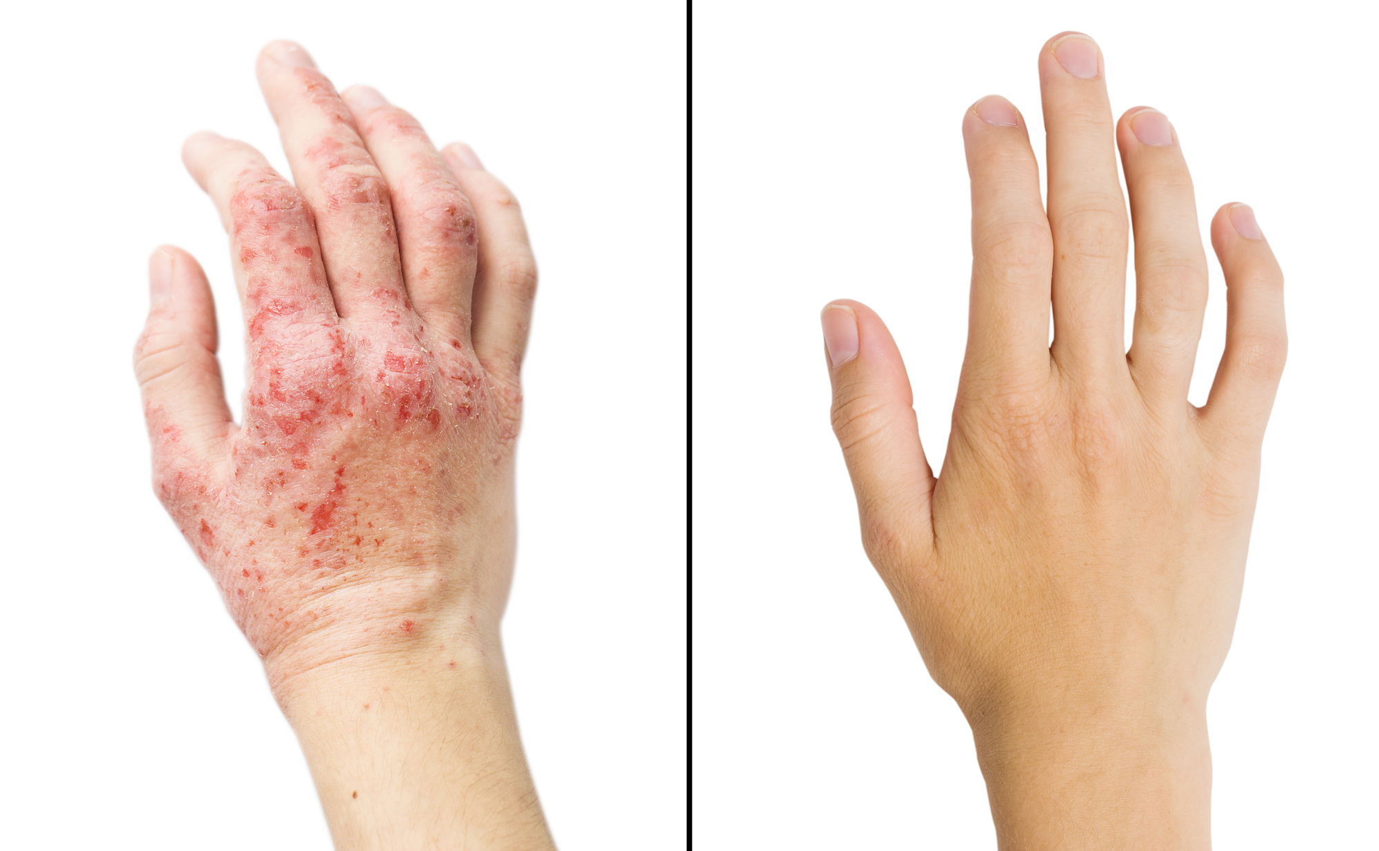 Pictures Of Eczema Contact Dermatitis Pictures