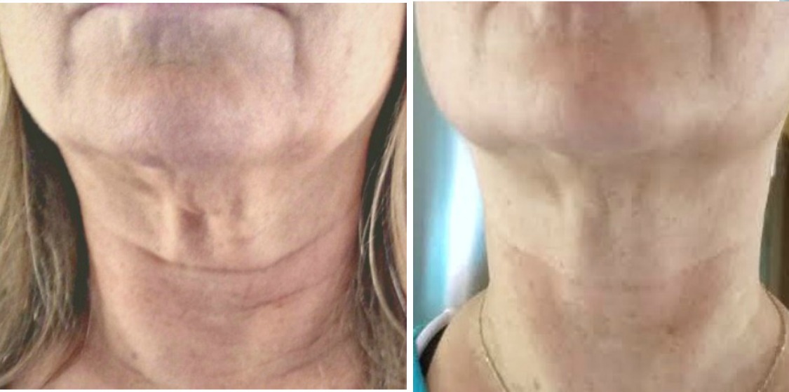 Crepey Skin Remedies - Natural Cure For Face, Eyes And Neck