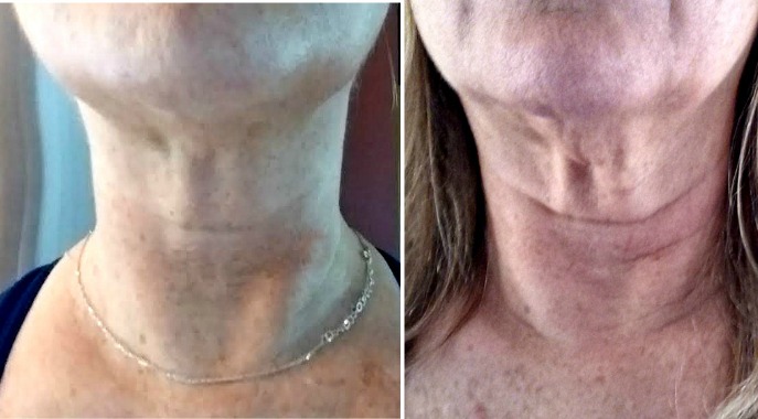skin neck facial chin double exercises sagging flex before wrinkle cheeks exercisers muscles under eliminate face exercise around help really