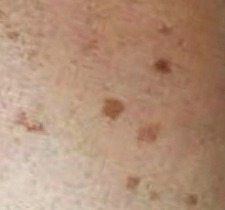 What Causes Age Spots And How To Treatment Them What Causes Age Spots And How To Treatment Them