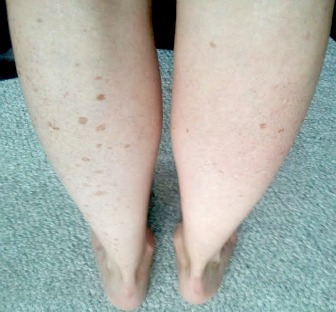 Age Spots On Legs? Hide Them! This Works.